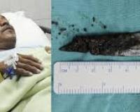 Канадские врачи не замечали нож в теле пациента в течение трёх лет!