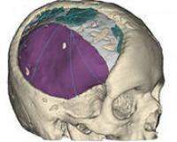Ученые: прозрачный имплантант в черепе поможет при травмах головы и раке мозга