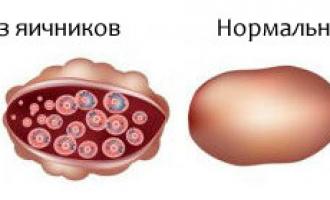 Синдром поликистозных яичников как одна из причин бесплодия